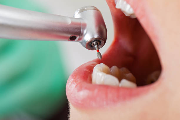 Best Emergency Dental Care for Broken or Chipped Teeth in Kent, OH
